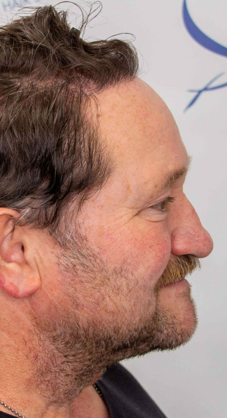 Robert 1 year Hair Transplant Result Right After 1500x2764