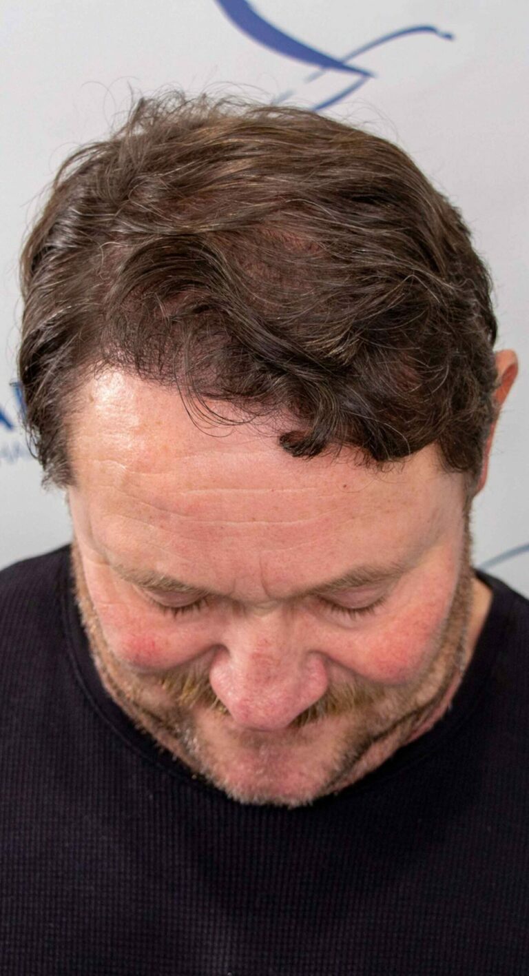 Robert 1 year Hair Transplant Result Top After 1500x2764