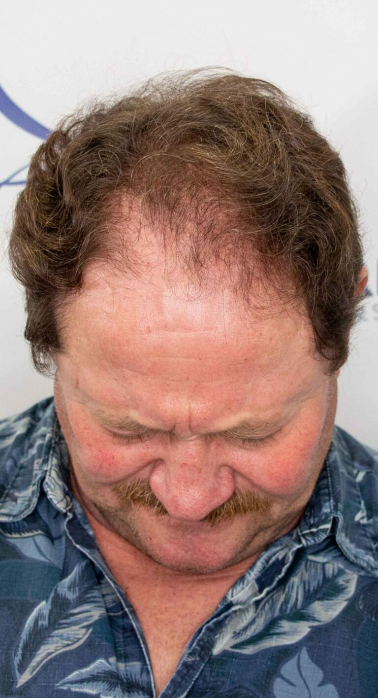 Robert 1 year Hair Transplant Result Top Before 1500x2764