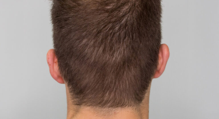 back of the head before hair transplant surgery