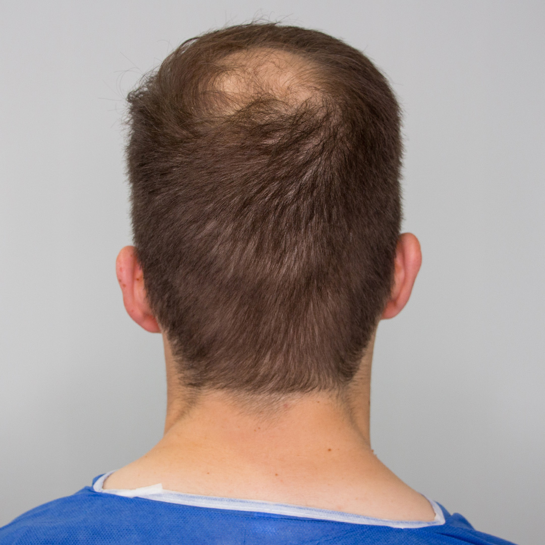 back of the head before hair transplant surgery
