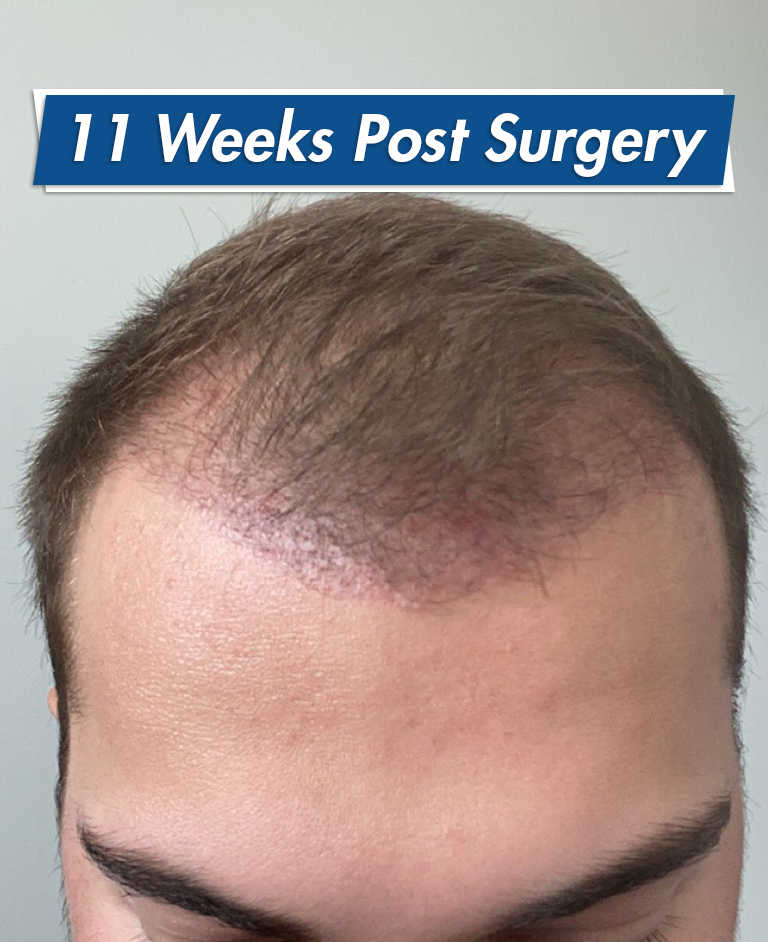 11 weeks post hair transplant surgery