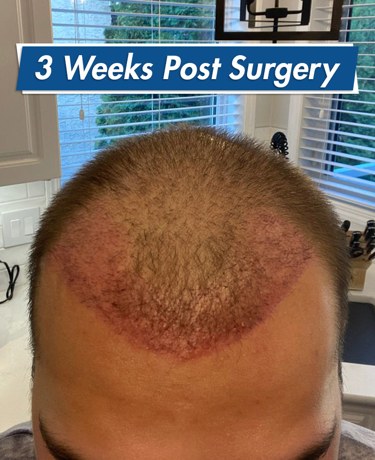 3 weeks post hair transplant surgery