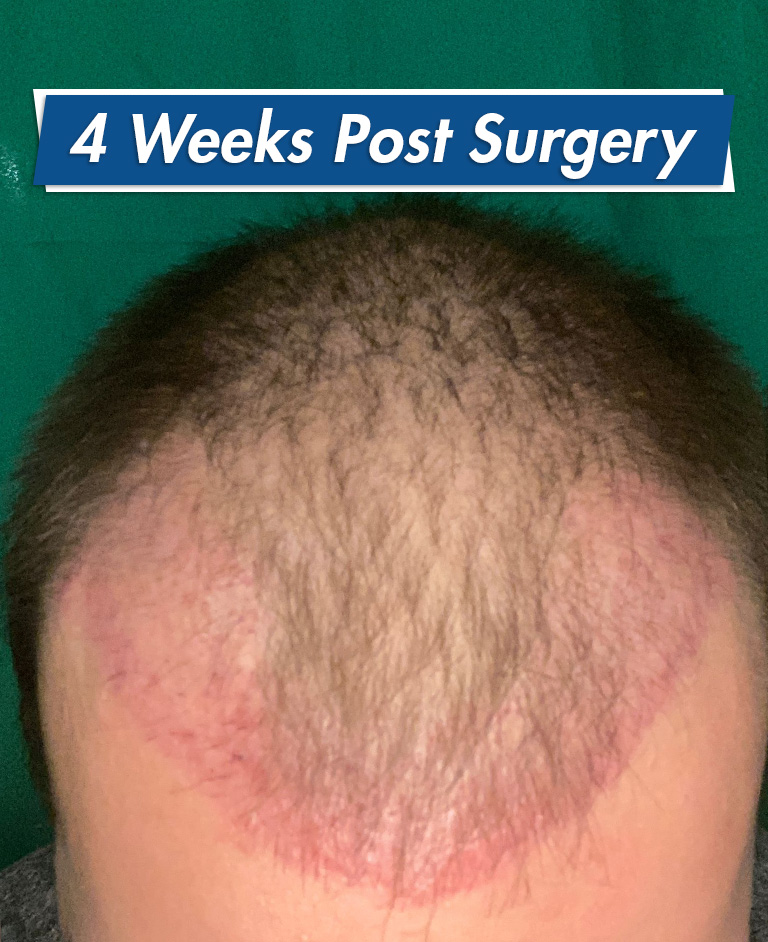4 weeks post hair transplant surgery