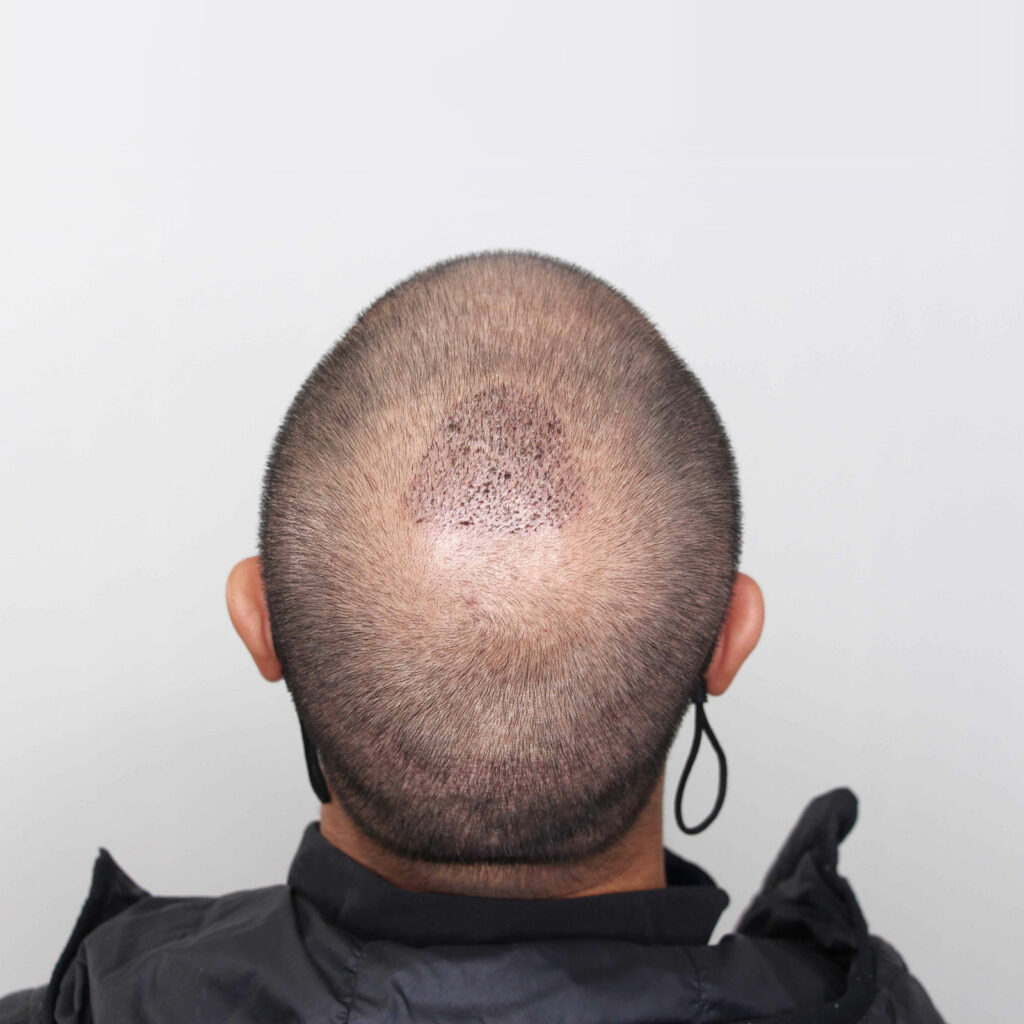 After a hair transplant one week later