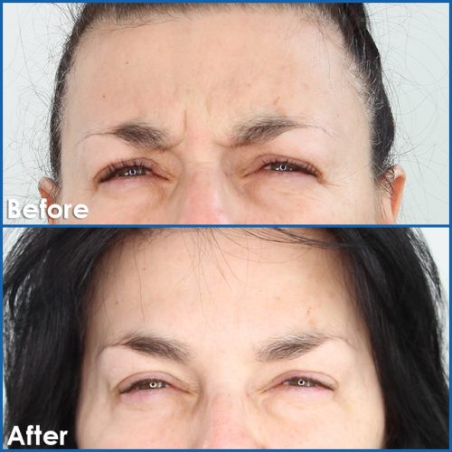 Botox result Straining Forehead oosuzq220k82sm45vebuj50ik3cmxu0sl6mfj815zc