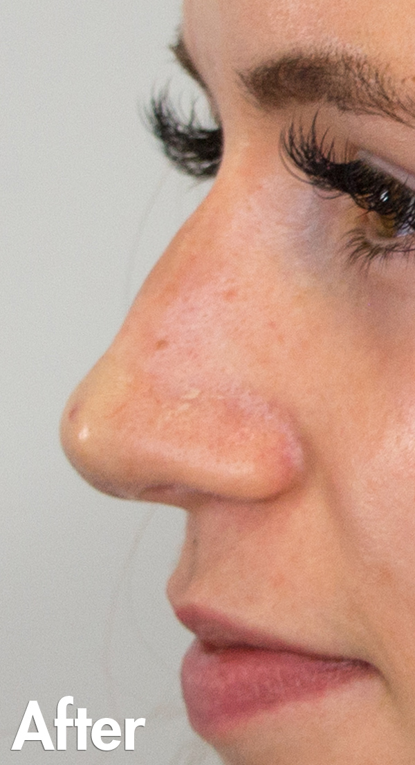 Court Non Surgical Rhinoplasty after