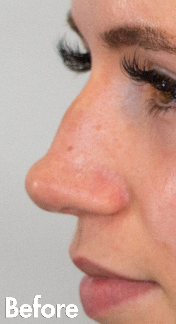 Court Non Surgical Rhinoplasty before