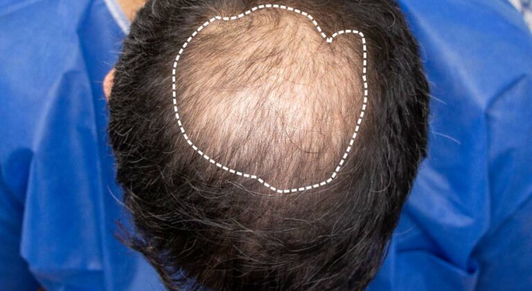 Crown Hair Loss Restoration Edmonton