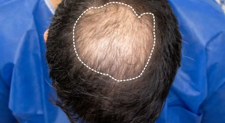 Toupee edmonton top