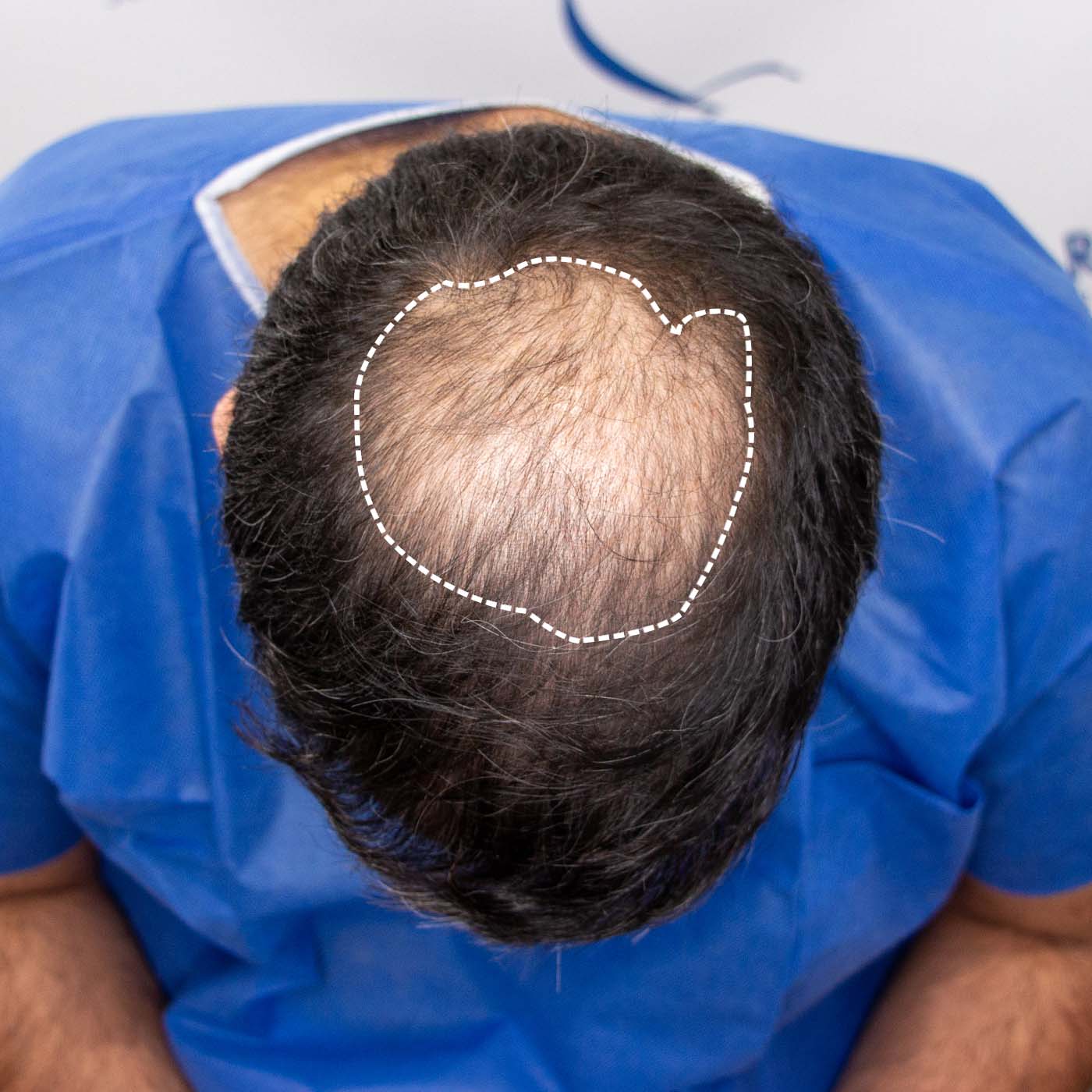 Crown Hair Loss Restoration Edmonton