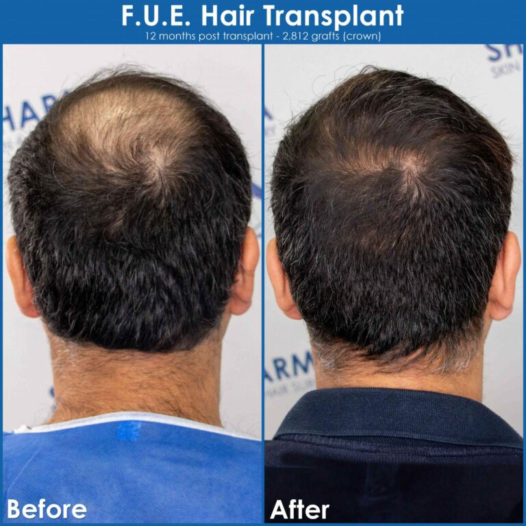 Crown hair loss before and after hair transplant result 2 scaled