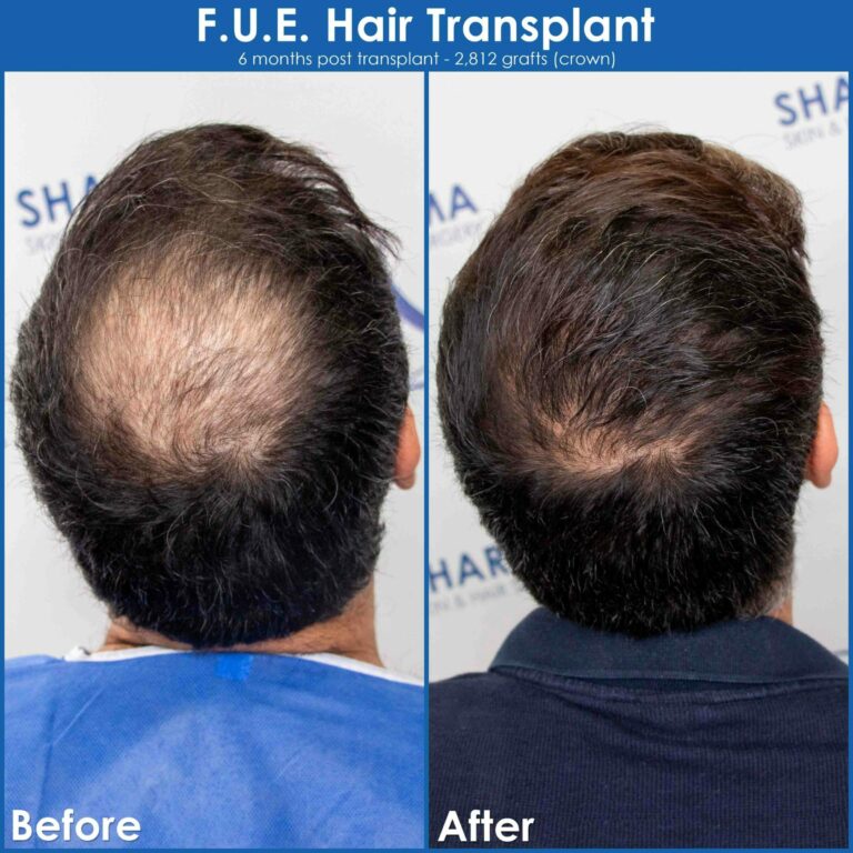 Crown hair loss before and after hair transplant result 3 scaled