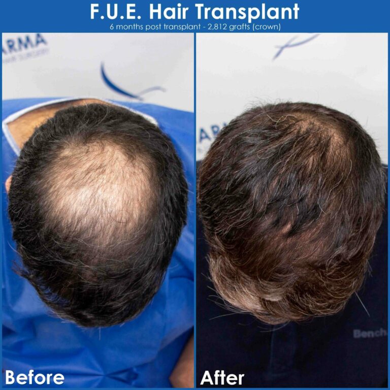Crown hair loss before and after hair transplant result scaled
