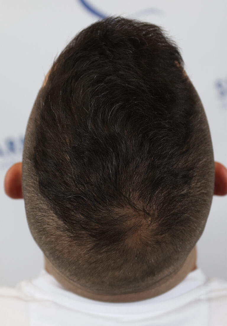 FUE hair transplant In Edmonton, Canada