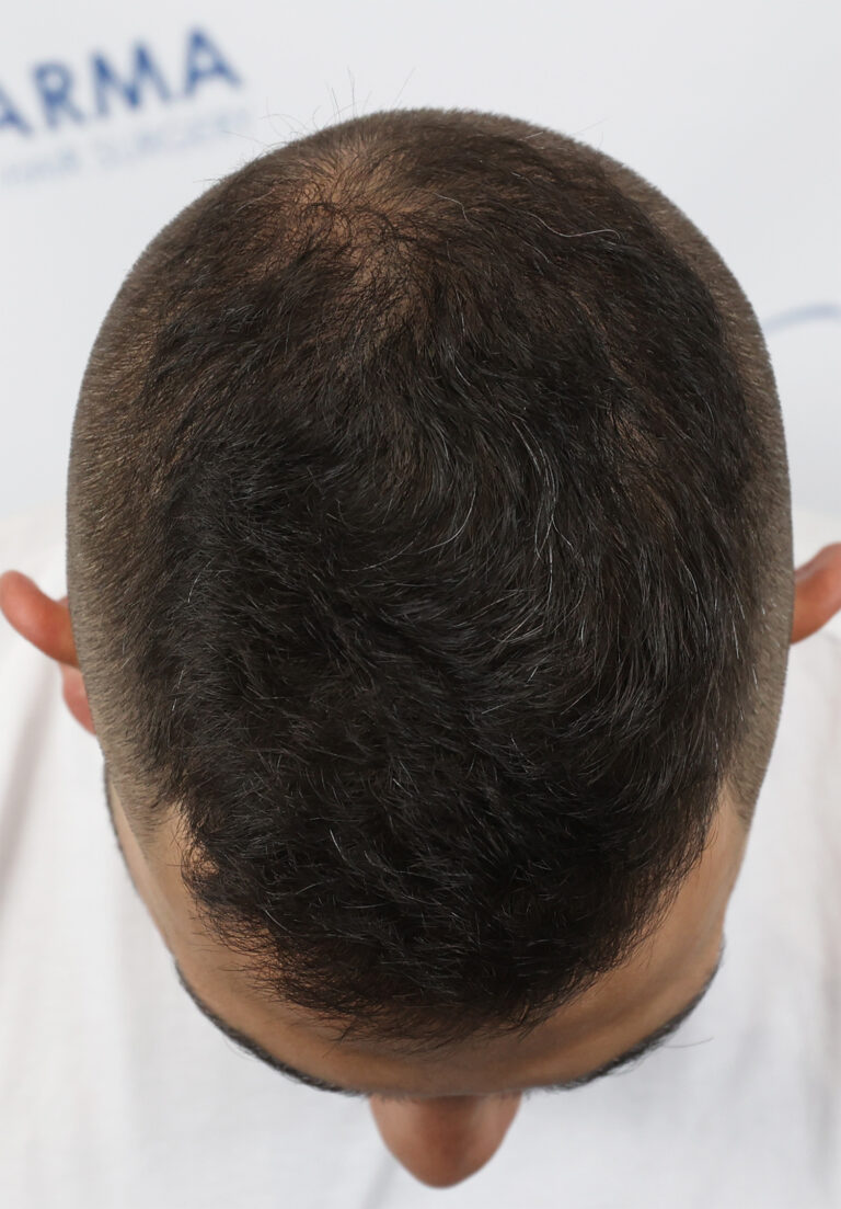 FUE hair transplant In Edmonton, Canada