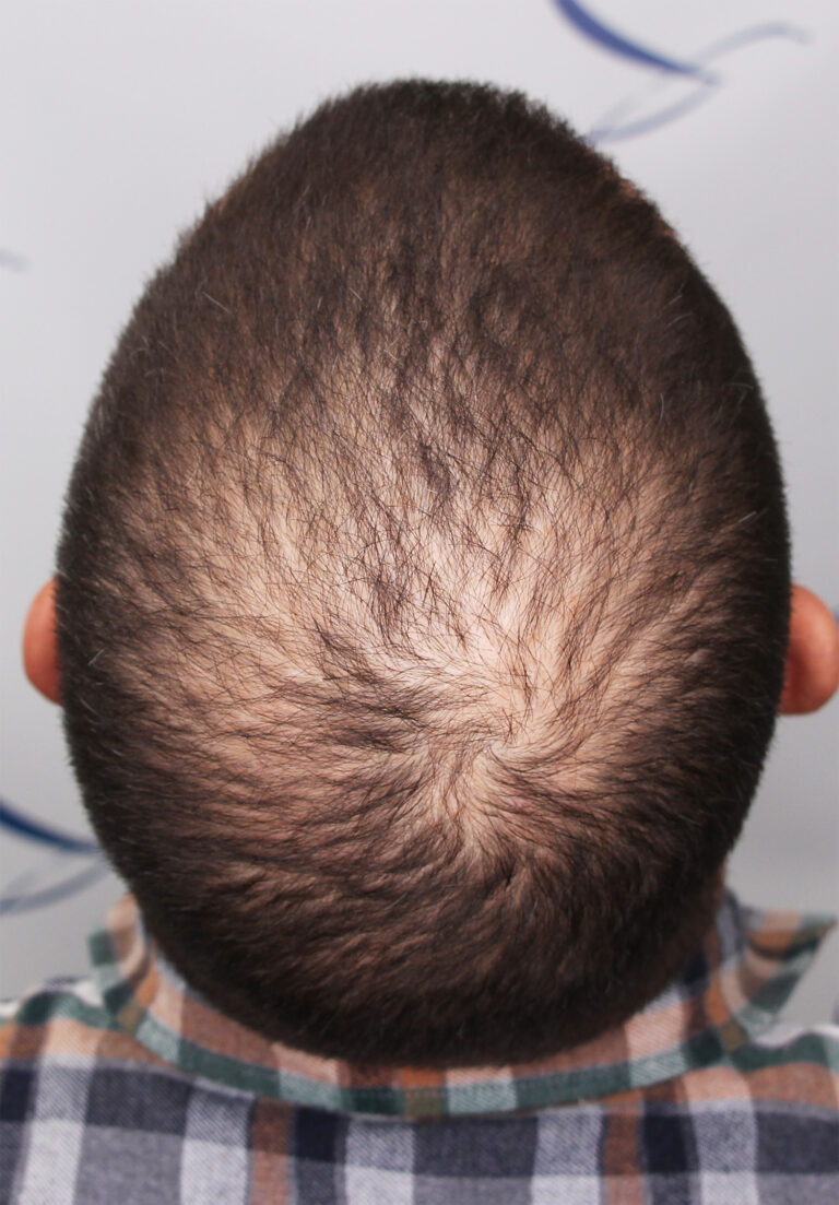 FUE hair transplant In Edmonton, Canada