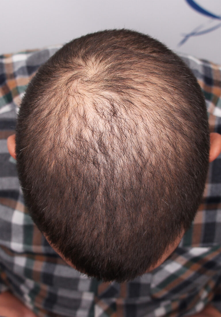 FUE hair transplant In Edmonton, Canada