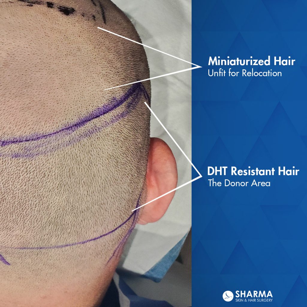 Donor Area with DHT Resistant Hair 1024x1024 1