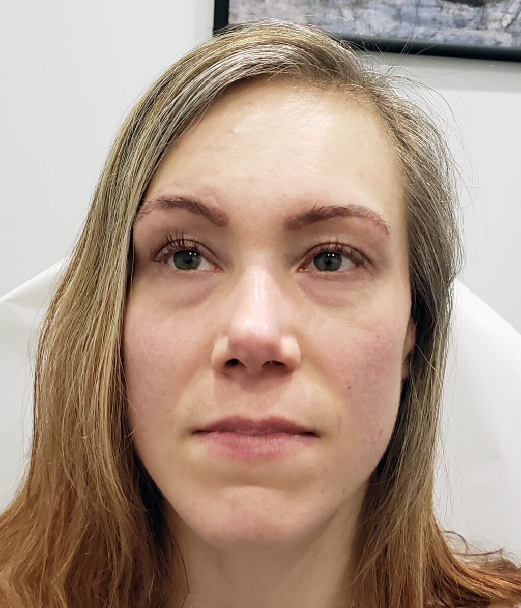 Eyebrow transplant 2 weeks post transplant