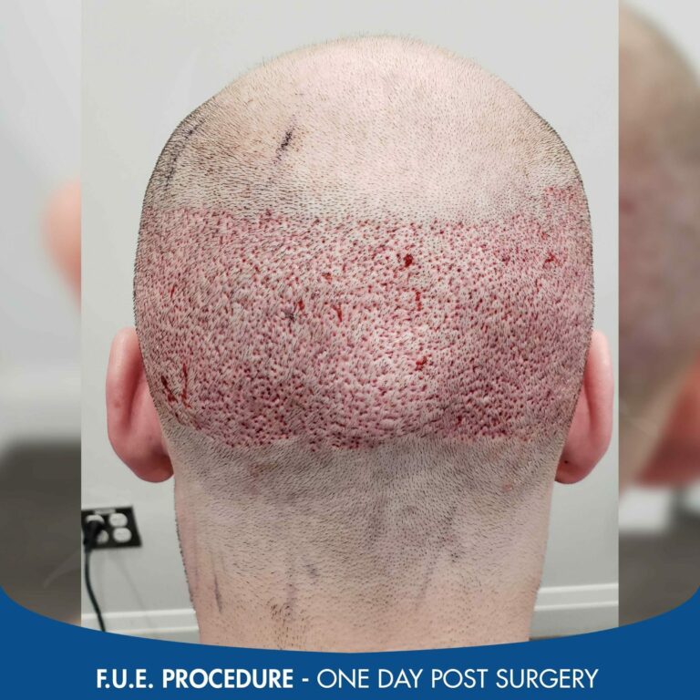 FUE scar one day post procedure 2 scaled