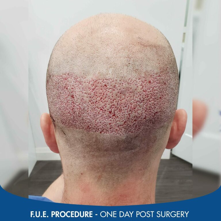 FUE scar one day post procedure scaled
