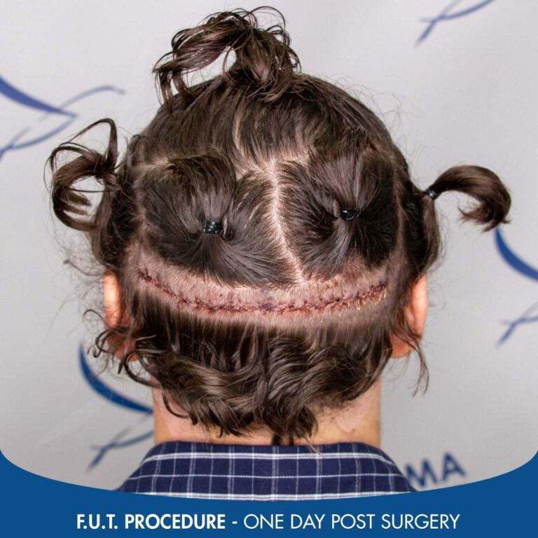 FUT scar one day post procedure 2 scaled 1