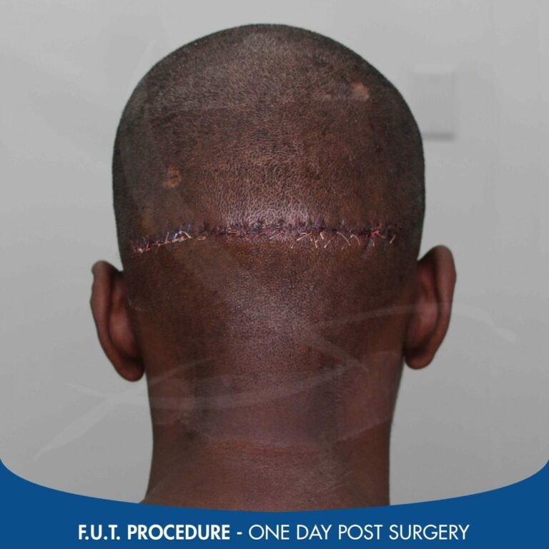 FUT scar one day post procedure scaled 1