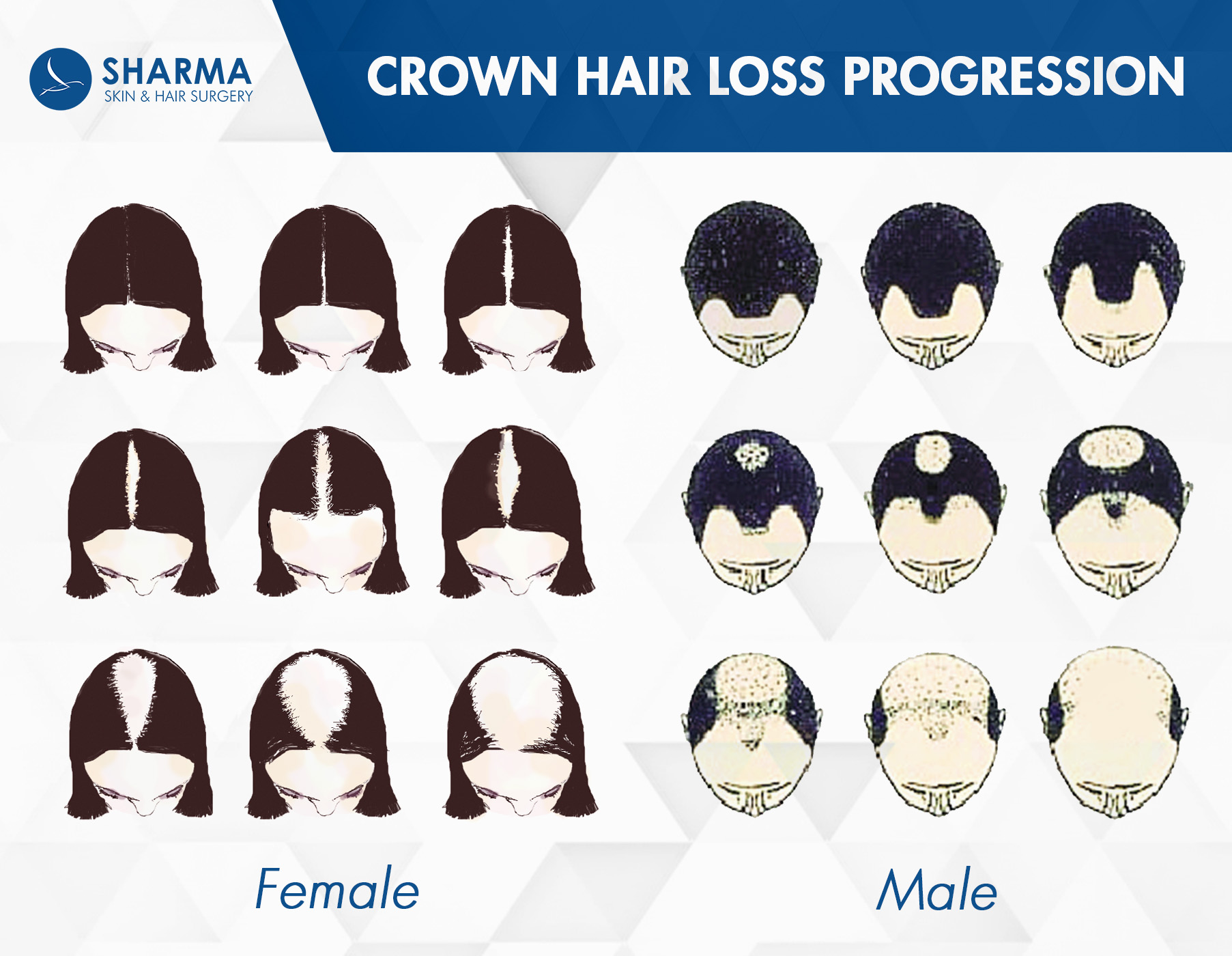 Female and male hair loss progression at the crown located at the top of the head 2