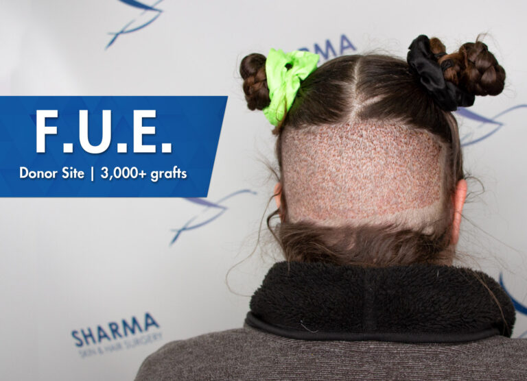 Female hair transplant donor site fue technique 2