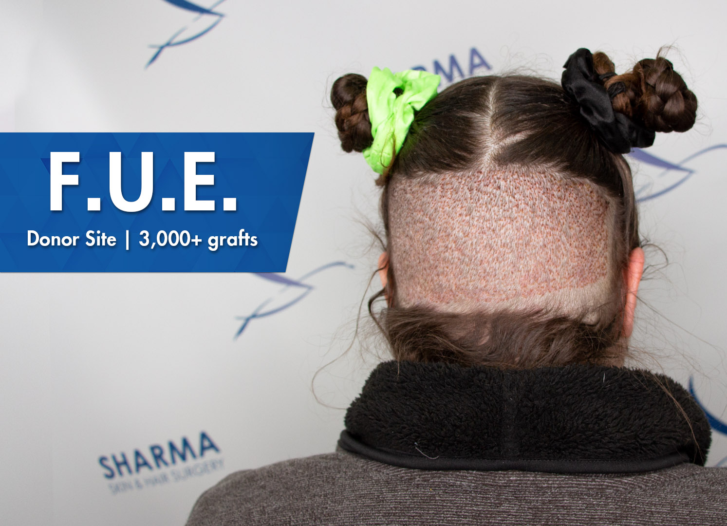 Revitalize Your Look with Advanced Hair Transplant Procedures