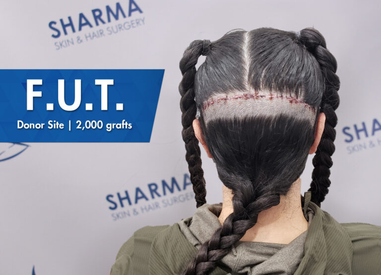 Female hair transplant donor site fut technique