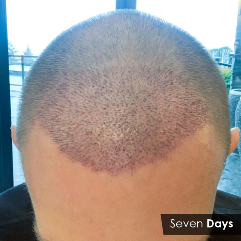 Hair Transplant Recovery 7Days