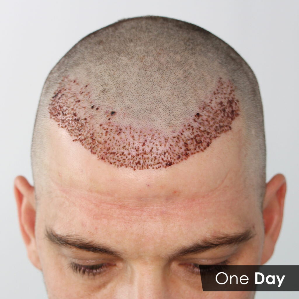Hair Transplant Recovery OneDay