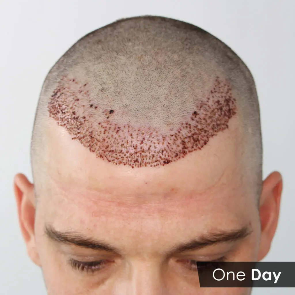 Hair Transplant in Shanghai