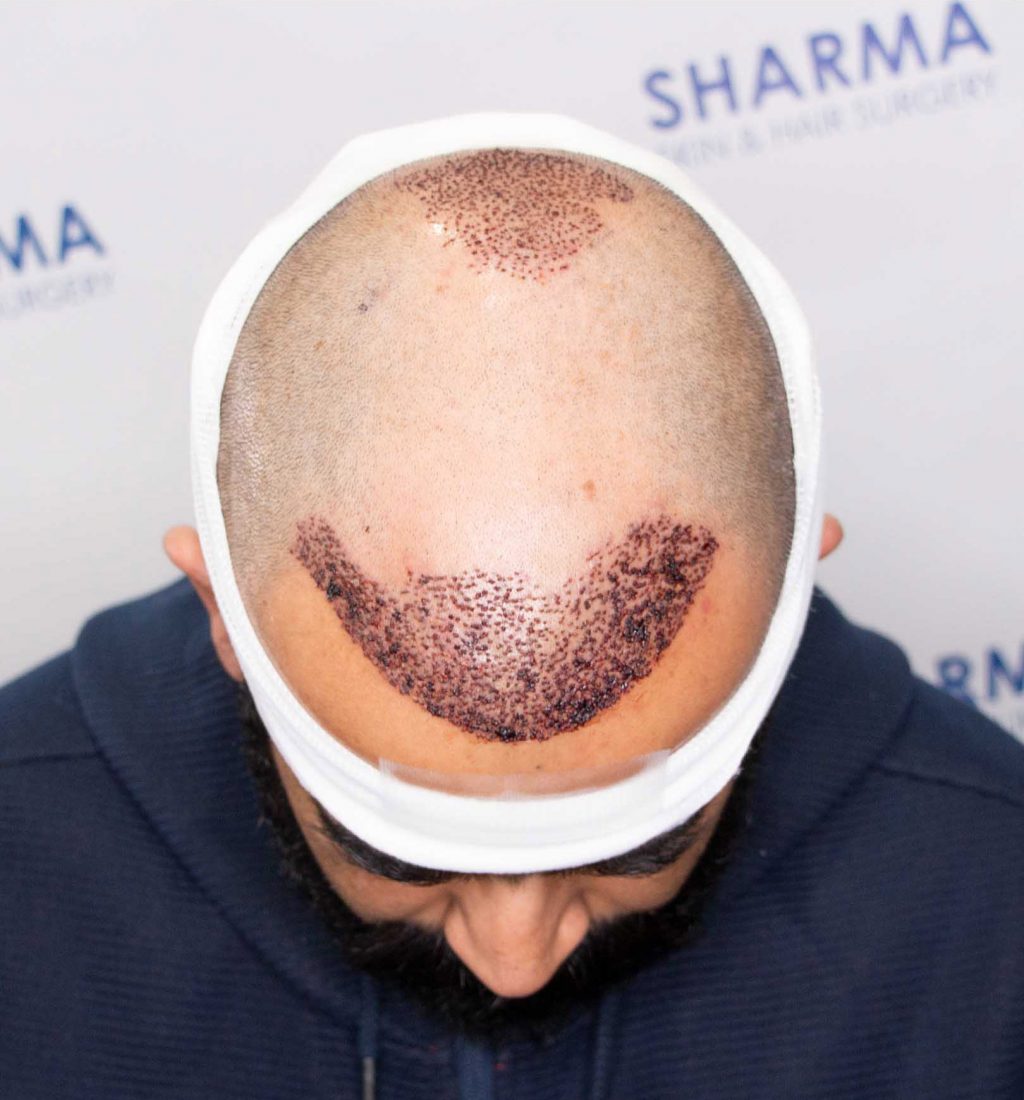 Hair transplant recovery one day after 1024x1100 1