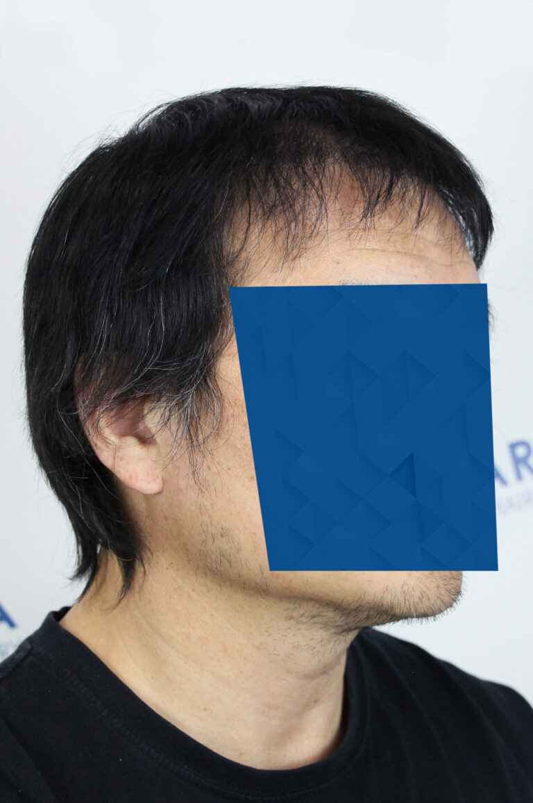 After photo of a hair transplant