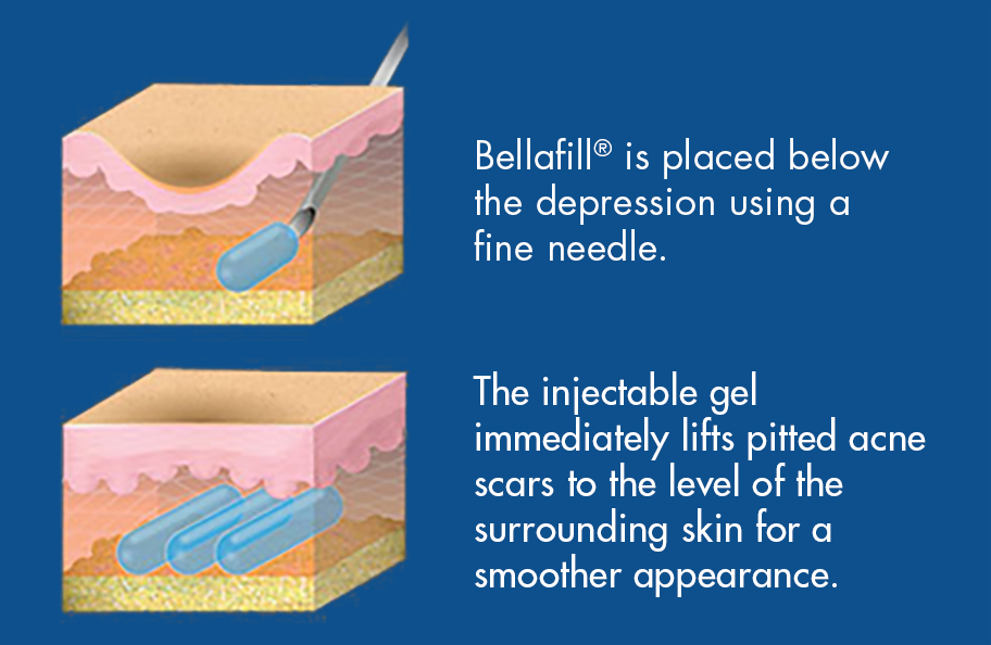 How does bellafill work diagram Sharma skin and hair surgery