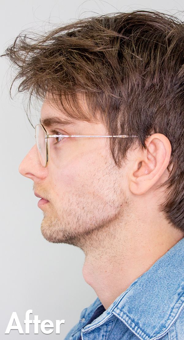Jaw Brett After
