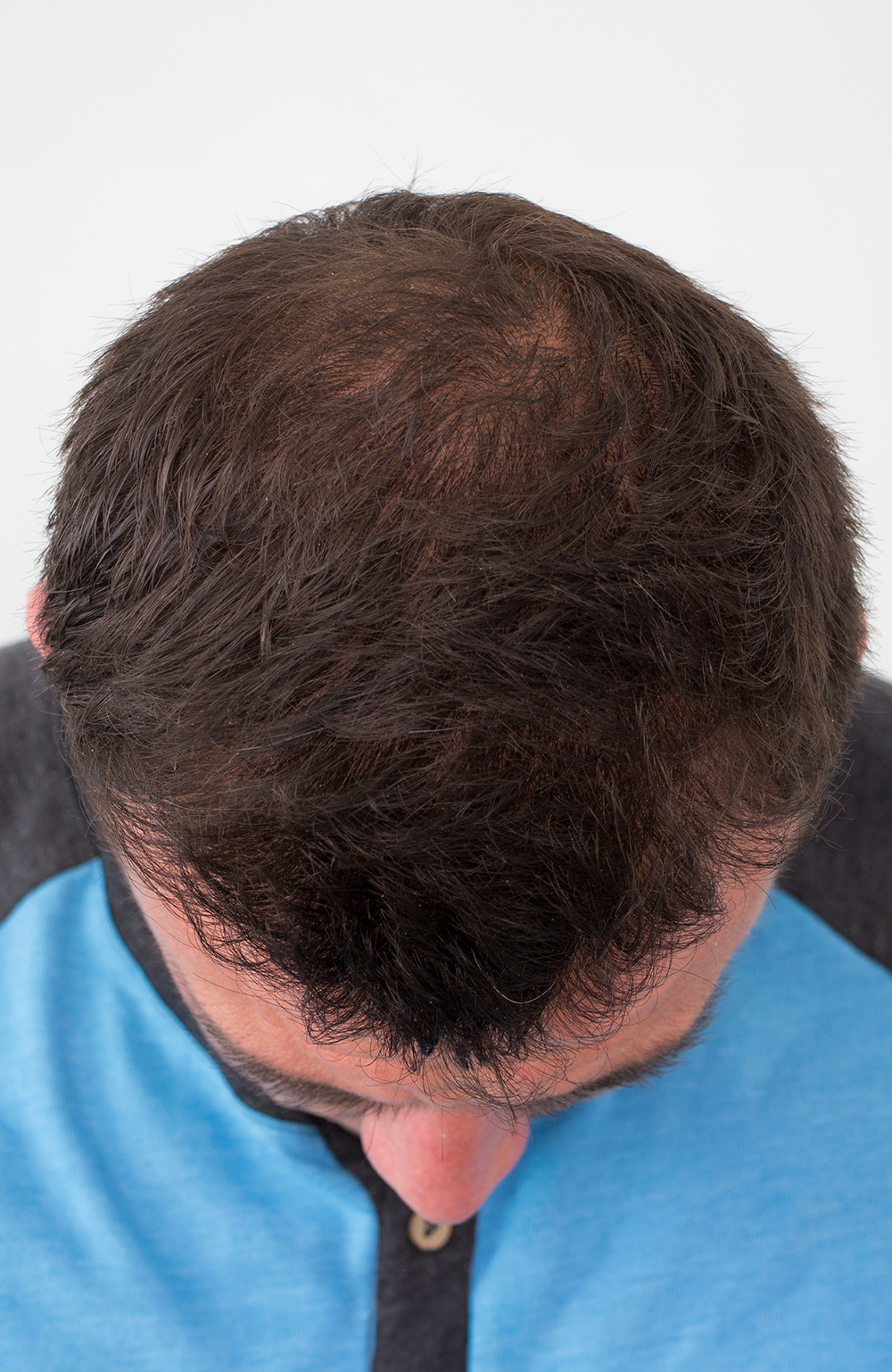 Julian hair transplant in edmonton - after