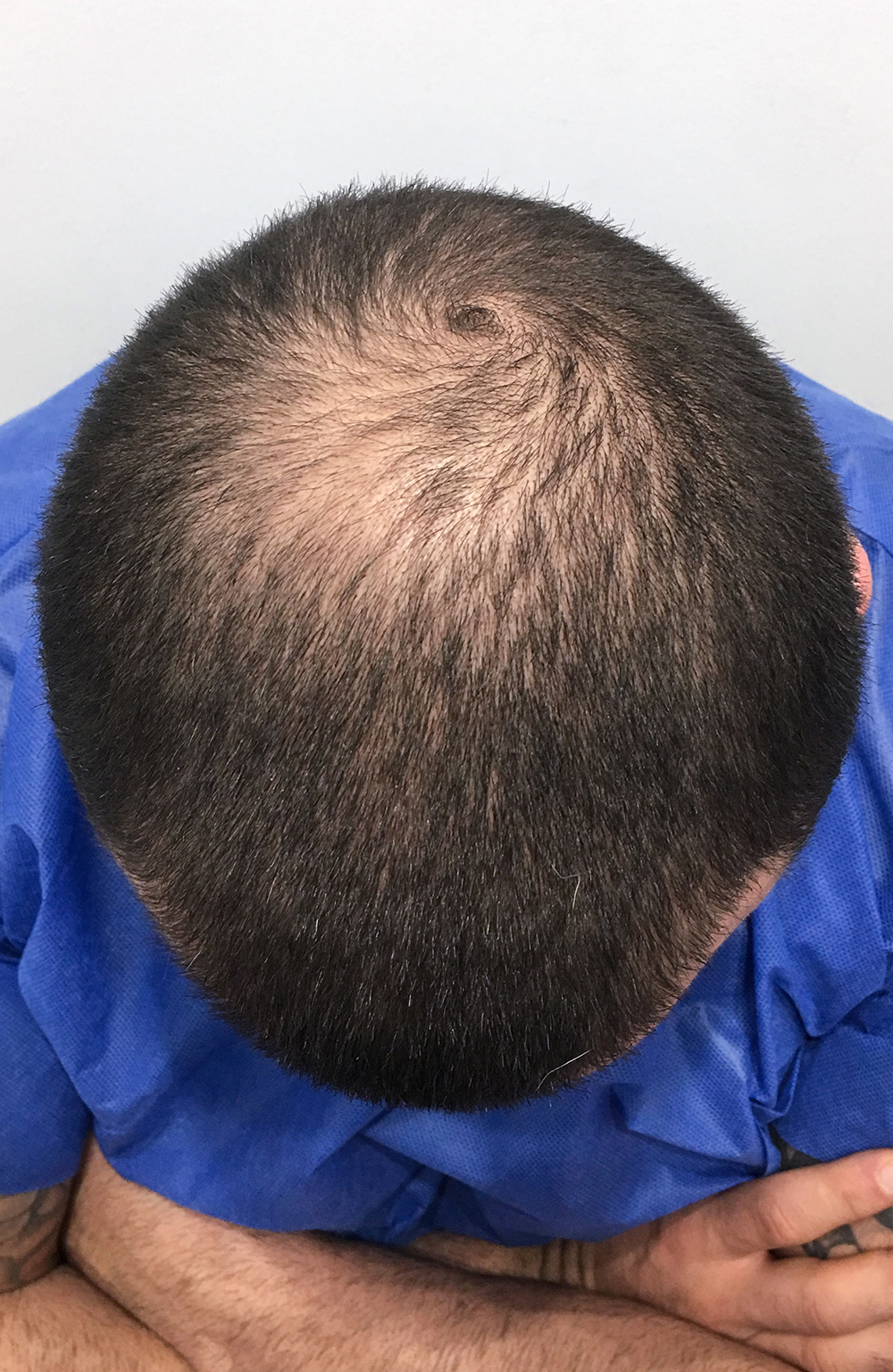 Julian hair transplant in edmonton - before