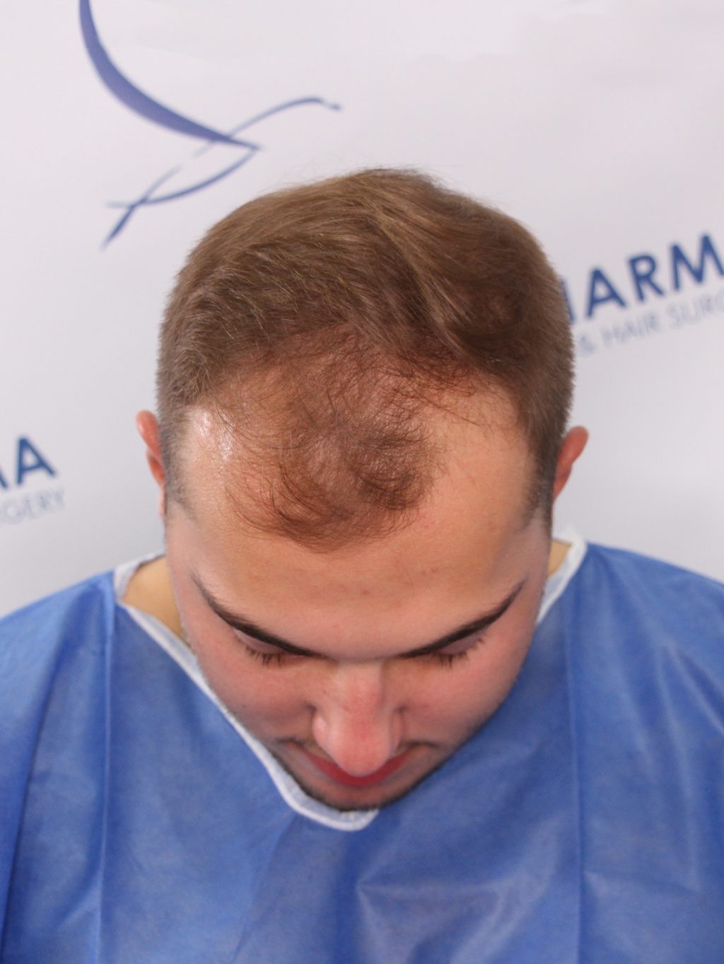 Kaleb Dahlgren before hair transplant top 1024x1363