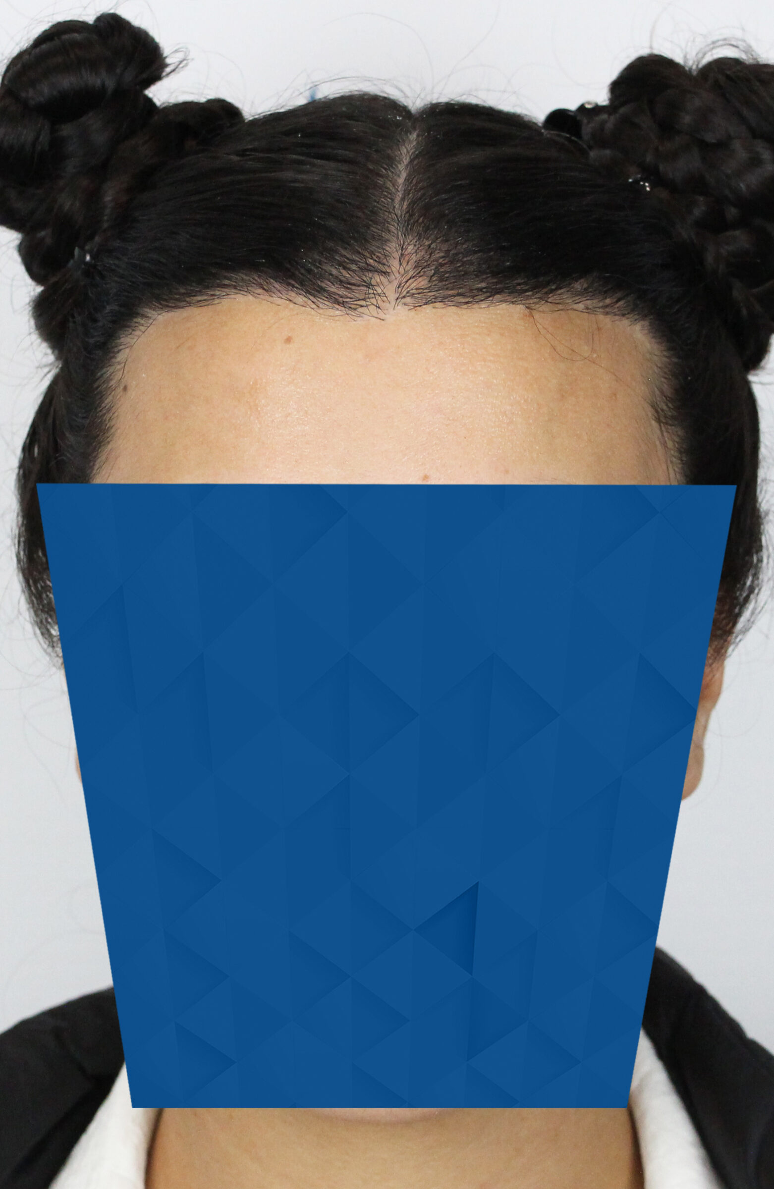 Female hairline lowering FUT