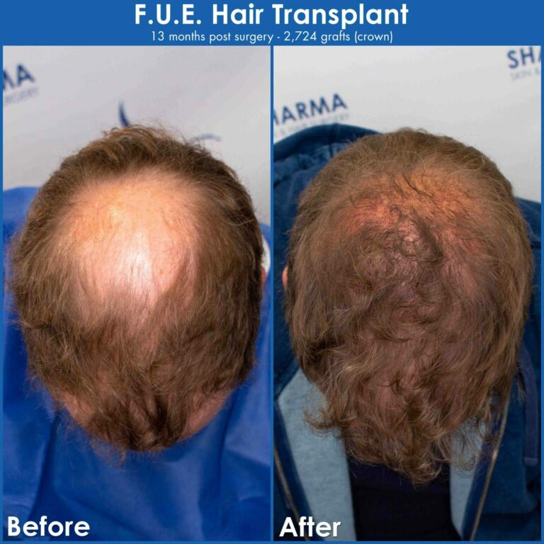 Large bald spot restoration with hair transplant results before and after photography scaled