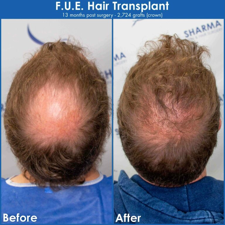 Large bald spot restoration with hair transplant results before and after photography2 scaled