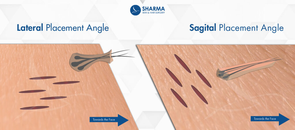 Lateral Slit Diagram3 1