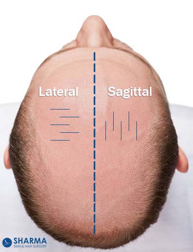 Lateral Slit Technique and sagittal slit techniques