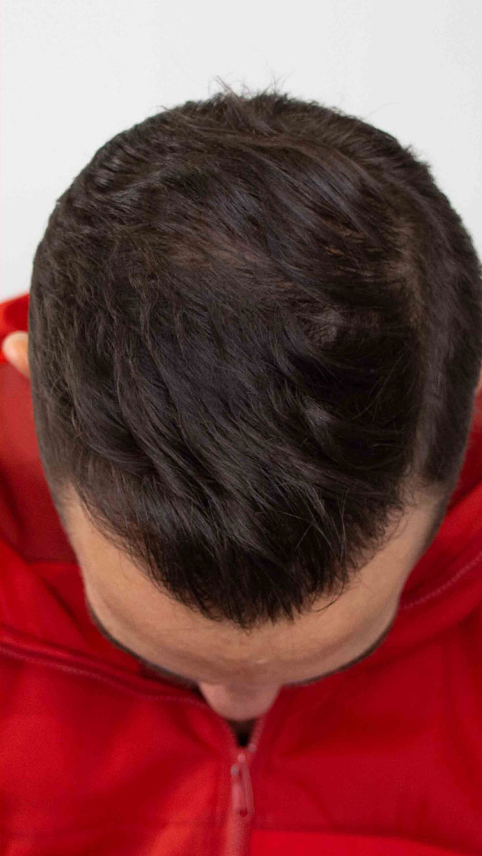 Man at one year post hair transplant crown top of head after