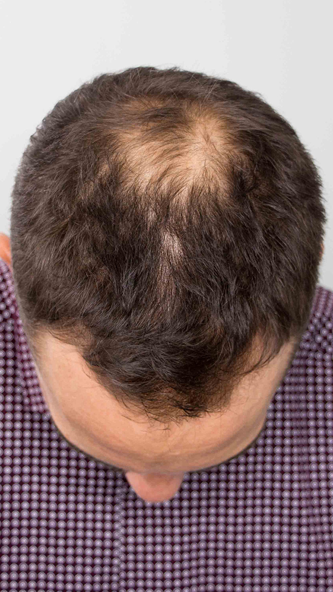 Man at one year post hair transplant crown top of head before
