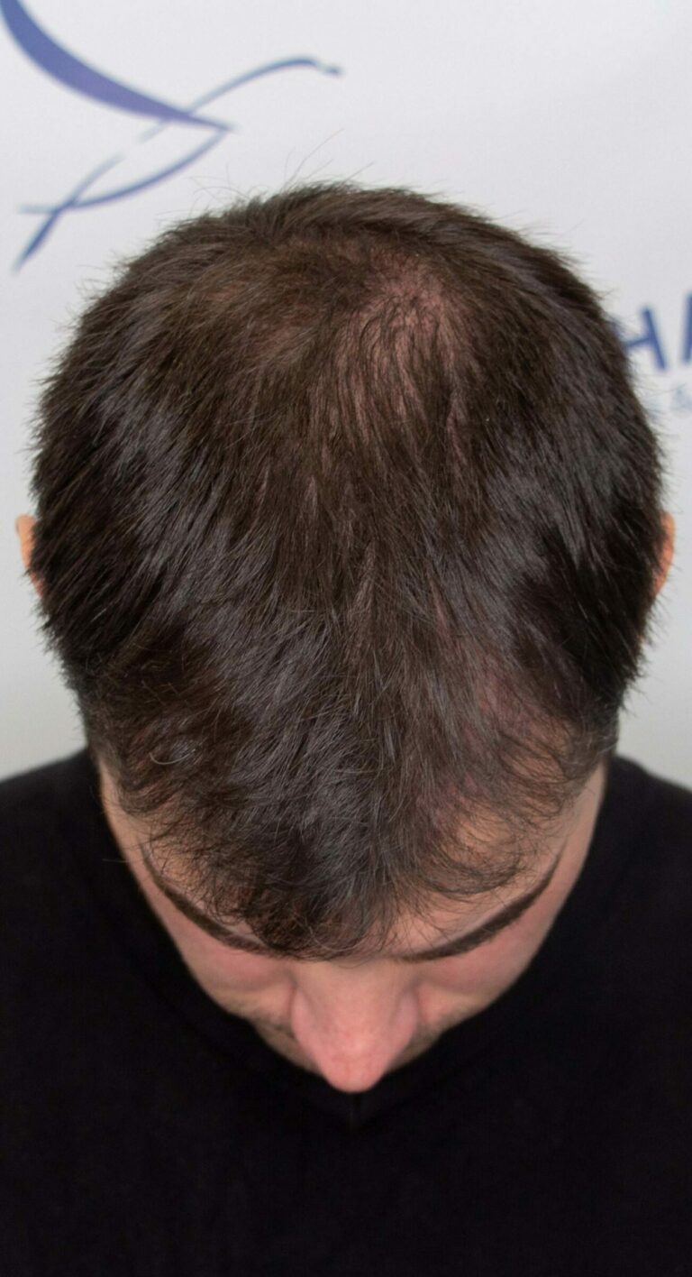 Matthew after hair transplant crown front 1500x2764